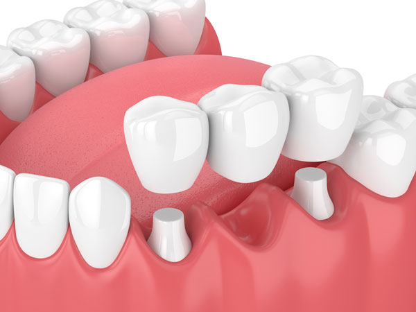 CROWN AND BRIDGES SMILE RE-CREATION