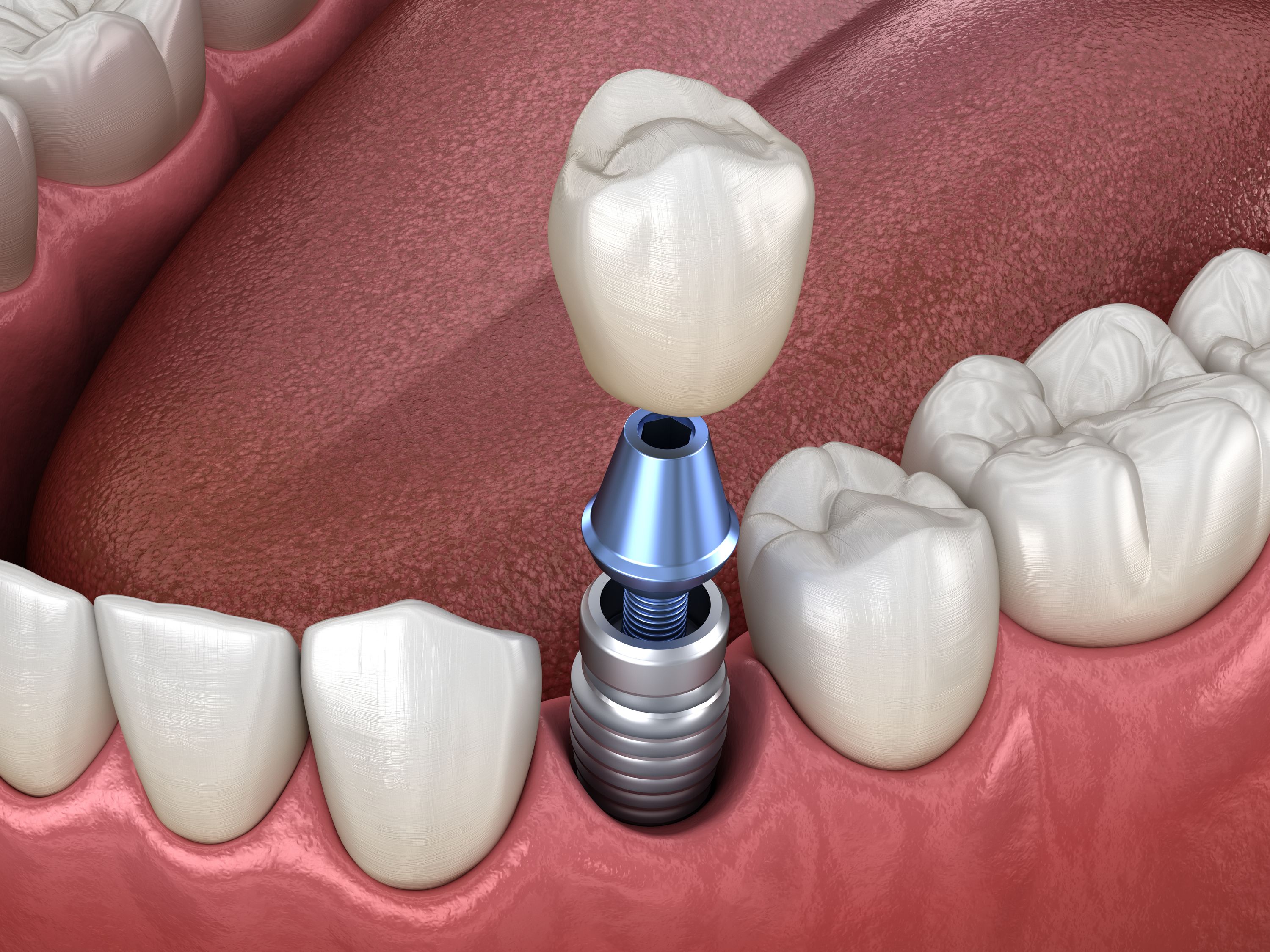 TIPS FOR MAINTENANCE OF DENTAL IMPLANTS