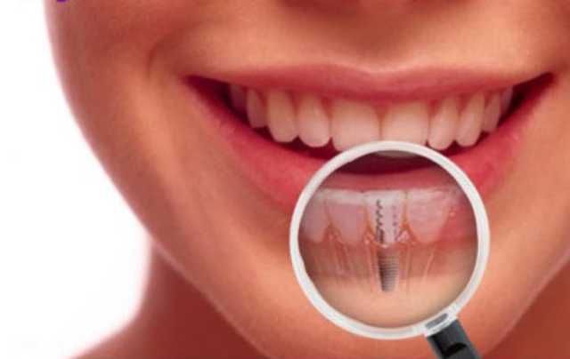 Dental Implants